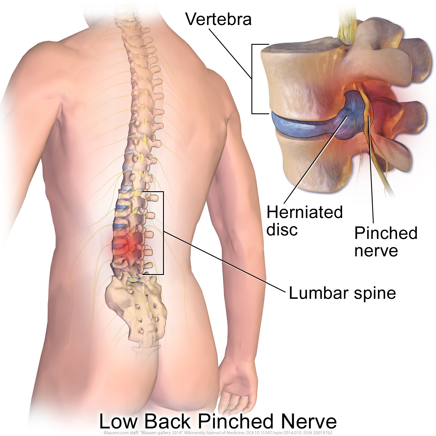 pinched nerve caused by disc herniation